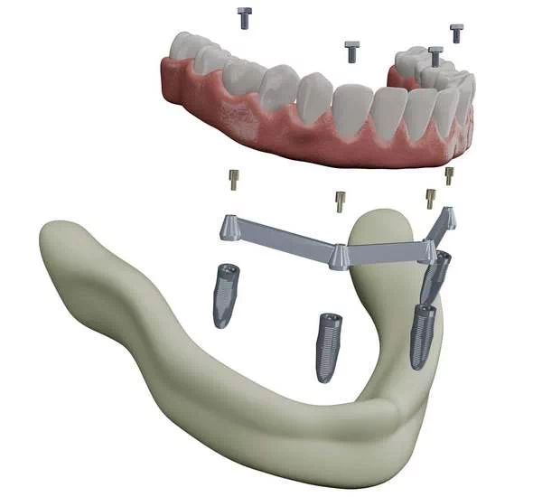 Affordable All-on-4 Implants in Alexandria, VA - What Are All-on-4 Dental Implants